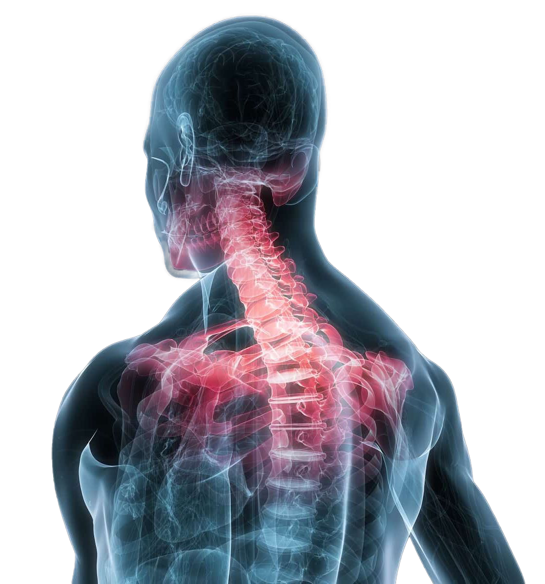 Chronic_Neck_Pain_3 - Bay Area Disc Center