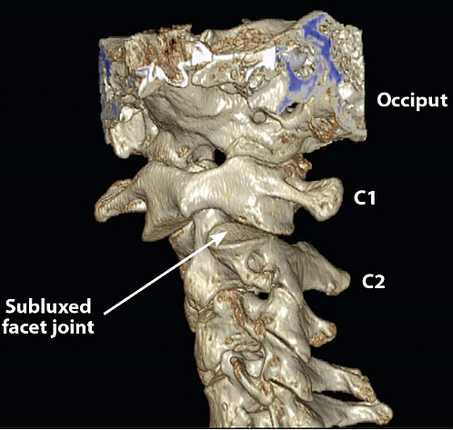 Subluxation of Cervical Facet - Bay Area Disc Center