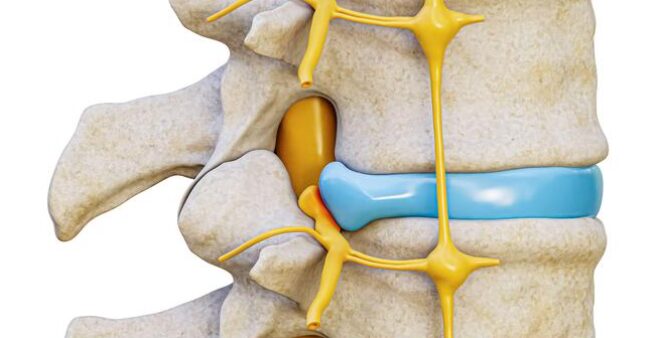 disc protrusion - Bay Area Disc Center
