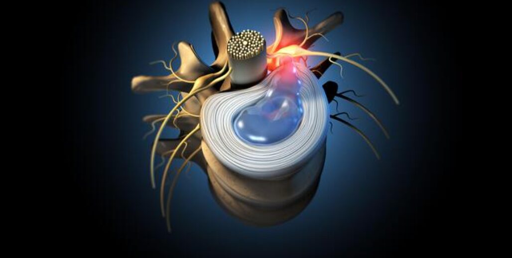 herniated disc 3d - Bay Area Disc Center