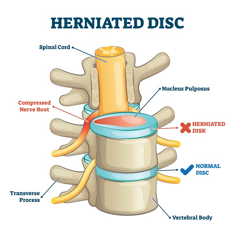 herniated disc model - Bay Area Disc Center