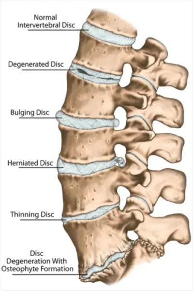 skeletal lumbar disc issues - Bay Area Disc Center