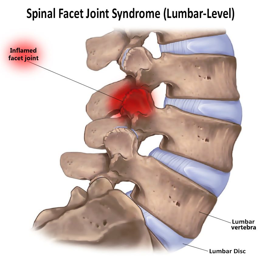 Facet-Syndrome-2 - Bay Area Disc Center